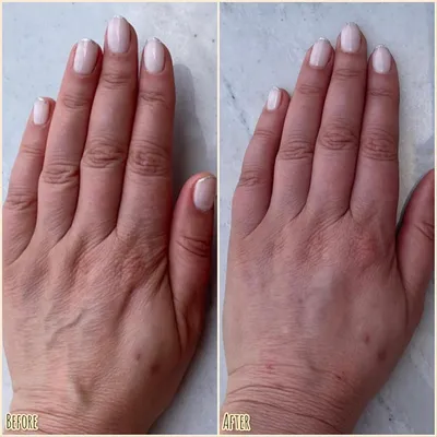 Фотографии заболеваний кожи рук: как ухаживать за кожей