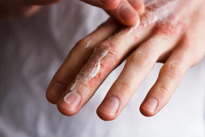 Фото заболеваний кожи рук: причины и лечение