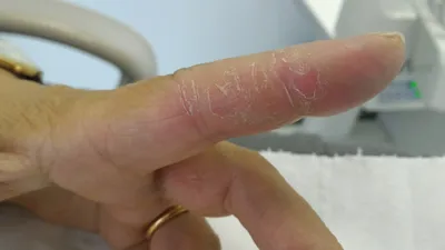Картинки заболеваний кожи рук: дерматит