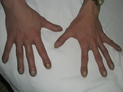 Симптомы заболеваний пальцев рук на фото