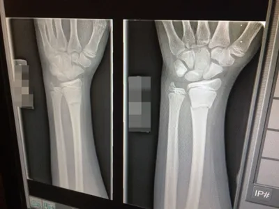 Рентгеновский снимок руки с закрытым переломом в высоком качестве