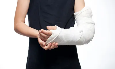 Изображение закрытого перелома руки с близкого расстояния