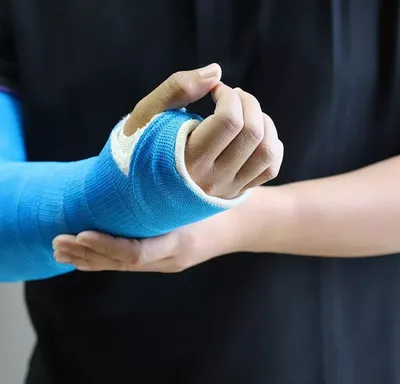 Изображение закрытого перелома руки: бесплатное использование