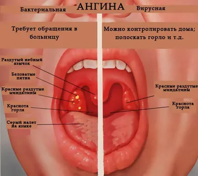 Как Выглядит Больное Горло Фото – Telegraph