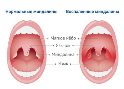 Лечение тонзиллита в Москве лазером - цена от 2500 руб