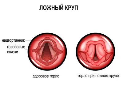 Гортань человека: что это, где находится, как выглядит и работает, почему  может болеть