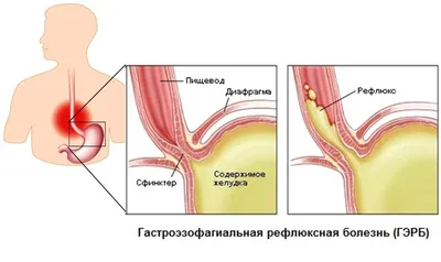 Стоматит 9 Фото Чем Лечить На Языке Десне ЛюмиДент