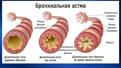 Боль в горле – как лечить и когда идти к врачу с болью в горле