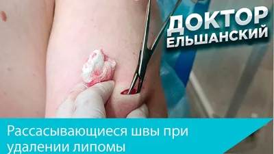 Картинка жировика на кисти руки в черно-белом исполнении