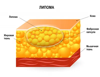 Жировик на кисти руки фотографии