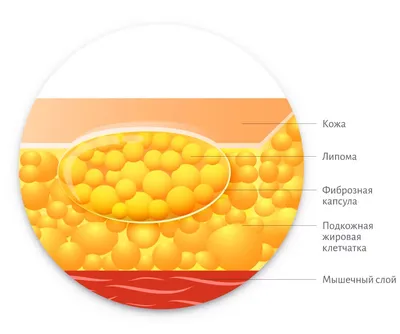 Картинка жировика на руке с меткой