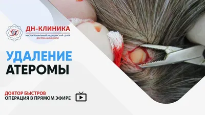 Изображение жировика на руке для медицинских исследований