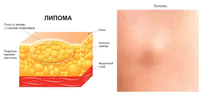 Воспаление жировика: симптомы, осложнения и лечение. Откуда берется липома  и как удалить новообразование