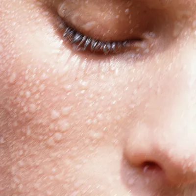 Какие бывают жировики на лице: 1. Белые жировики на лице – угри. Их внешний  вид очень сильно напоминают милиумы, в отличие которых они… | Instagram