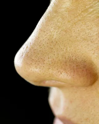 Как сократить жировики на лице: эффективные методы для безупречной кожи |  Красота в Гармонии с Здоровьем: Твой Гид к Идеальному Образу в Одном месте  | Дзен