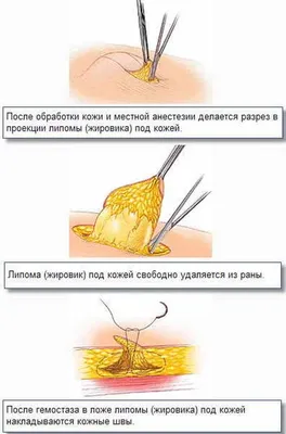 Удаление жировика на лице –... - alena_kosmetolog_aktobe | Facebook