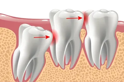 Зуб мудрости: фото, которое поможет вам понять симптомы