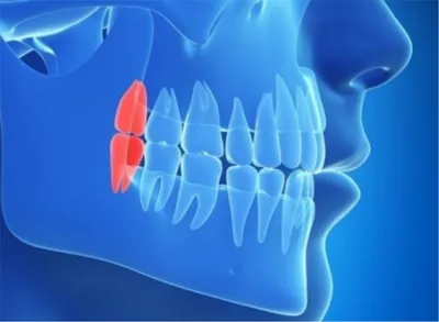 Фотография зуба мудрости: какие признаки указывают на проблемы