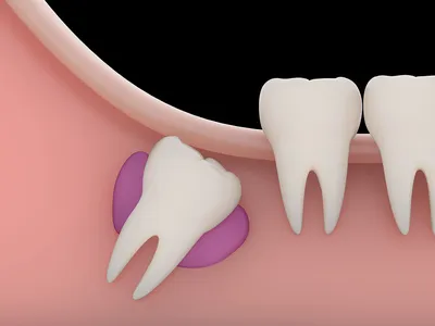 Изображение зуба мудрости: какие симптомы нужно обратить внимание