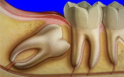 Фото зуба мудрости: какие симптомы указывают на нормальный рост