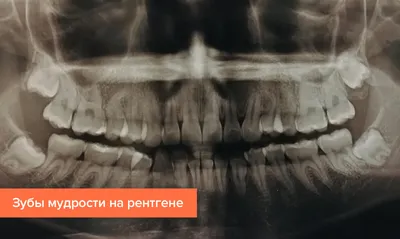 Картинка зуба мудрости: какие симптомы указывают на проблемы с зубом