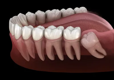Изображение зуба мудрости: какие симптомы указывают на неправильный рост