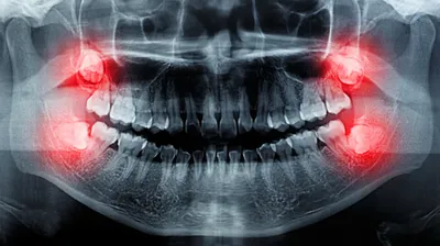 Изображение зуба мудрости: какие симптомы указывают на его рост