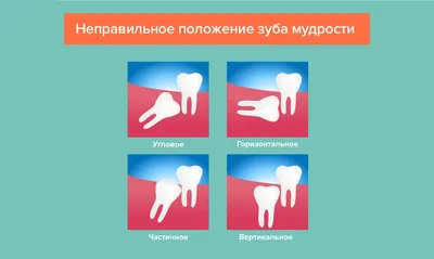 Симптомы проблем с зубом мудрости: фото и описание