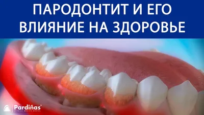 Фото зуба мудрости: какие симптомы необходимо учитывать