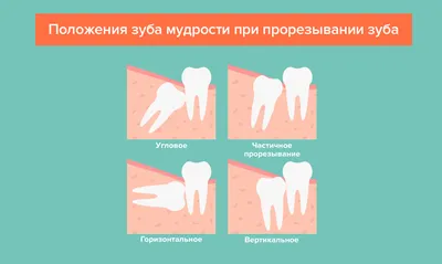 Изображение зуба мудрости: какие симптомы необходимо обратить внимание