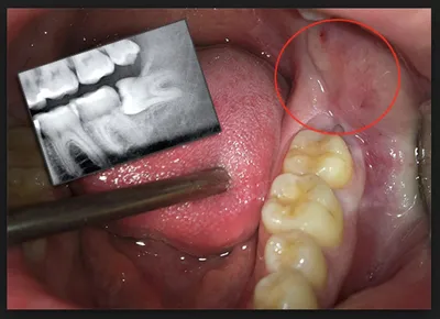 Фото зуба мудрости: какие симптомы могут требовать удаления