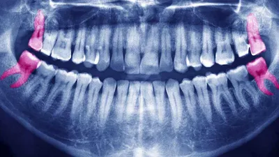 Картинка зуба мудрости: какие признаки говорят о необходимости удаления