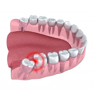 Изображение зуба мудрости: какие симптомы могут говорить о осложнениях