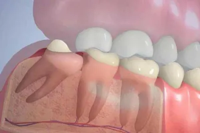 Изображение зуба мудрости: какие симптомы могут требовать дополнительных исследований
