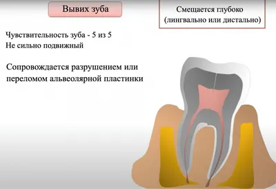 Как выглядят симптомы Зуба Мудрости на фото?