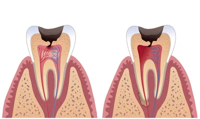 Как выглядят симптомы прорезывания Зуба Мудрости на фото?