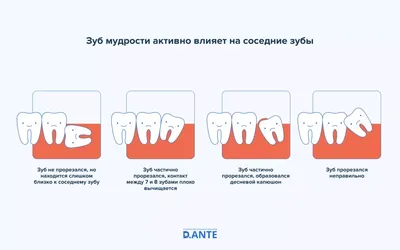 Фотография: Симптомы проблем с Зубом Мудрости