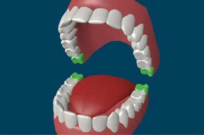 Зуб мудрости на фотографии: какие симптомы нельзя игнорировать