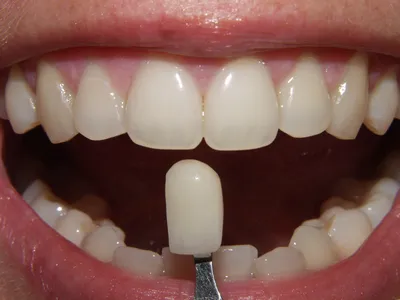 Фото зубов после снятия косметических виниров