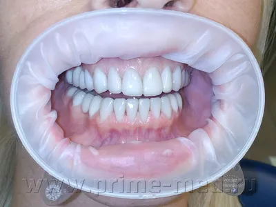 Зубы После Снятия Виниров фотографии