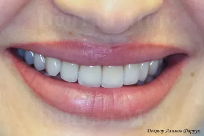Изображение зубов без виниров: прежде и после