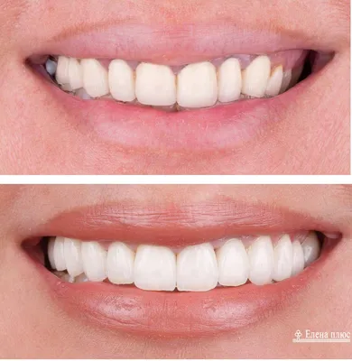Фотография зубов после снятия косметических виниров