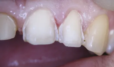 Фото зубов после процедуры снятия косметических виниров