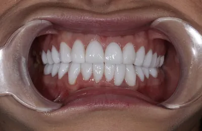 Картинка зубов без косметических украшений