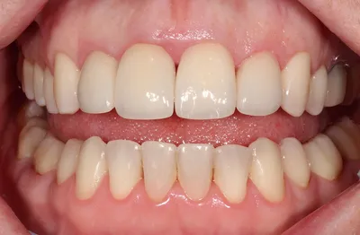 Изображение зубов после снятия косметических виниров: реальный опыт