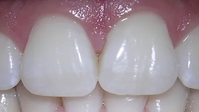 Фото зубов без косметических дополнений: что важно знать