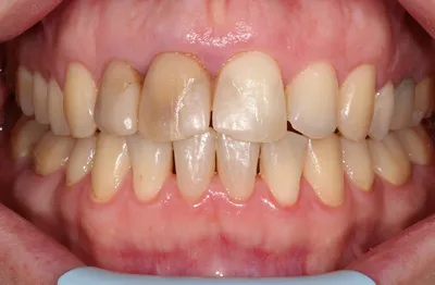 Как выглядят зубы после удаления виниров: фотоотчет