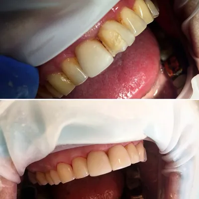 Фото зубов после снятия косметических украшений