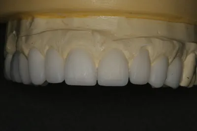Как выглядят зубы после удаления виниров: фотоотчет пациента