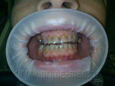 Фото зубов после снятия косметических дополнений: реальный результат